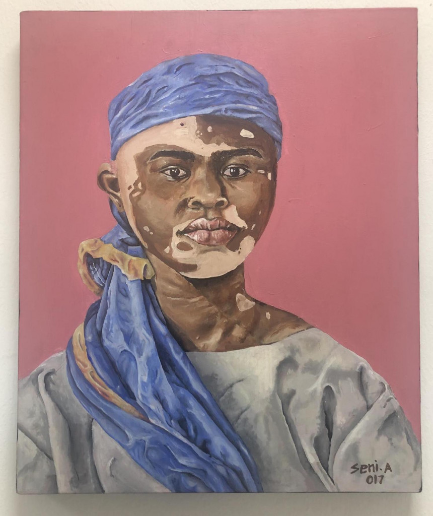 Oluwanseni Akinyemi's Vitiligo Beauty. Acrylic on canvas